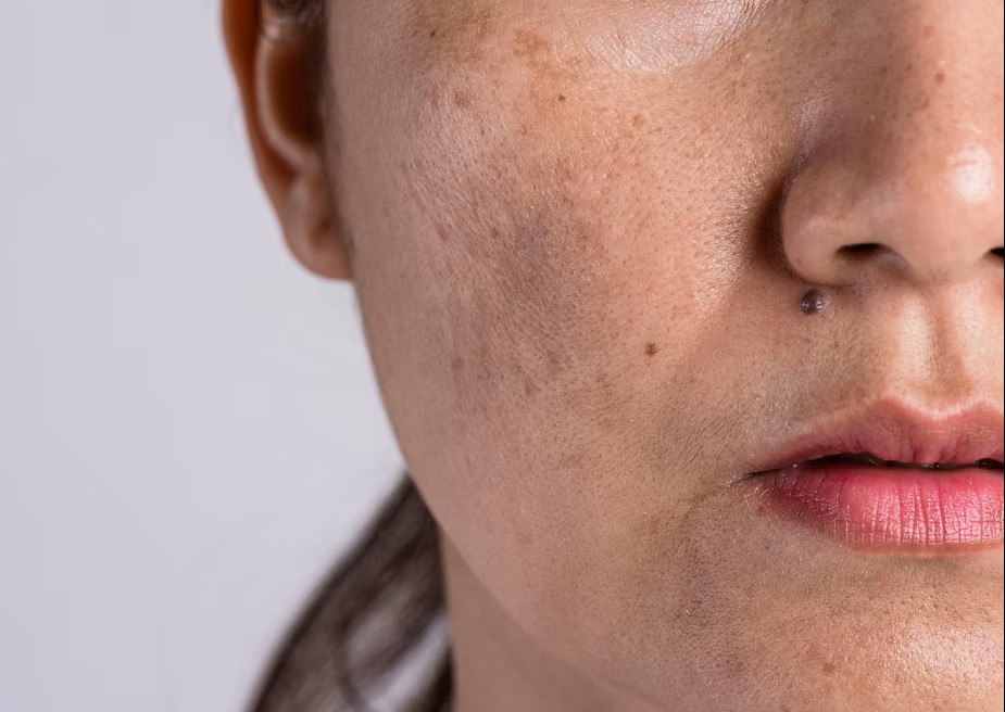 Manchas na pele depois dos 40: o que está por trás delas?